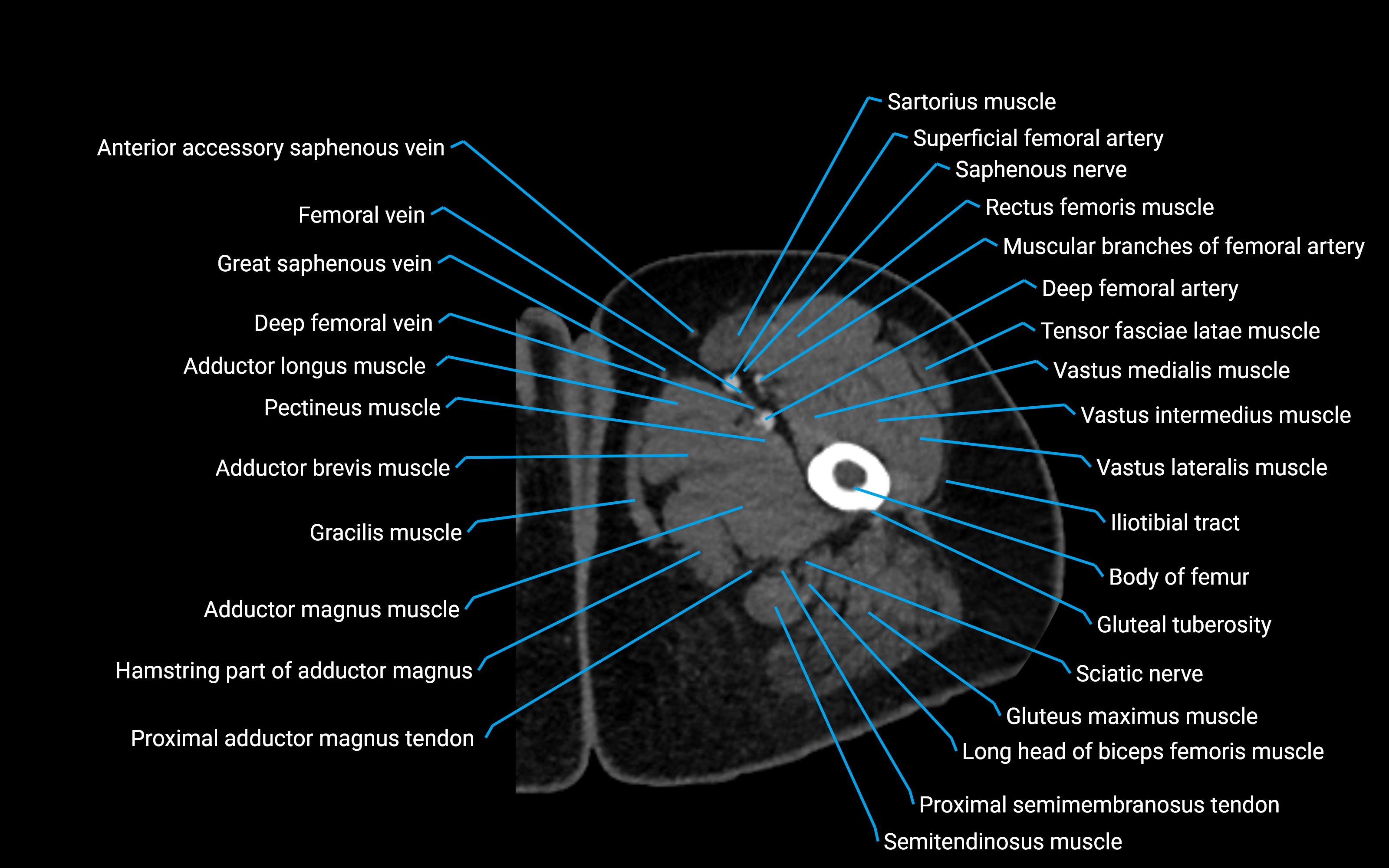 CT Hip axial cross sectional anatomy labelled image 24 (2).png